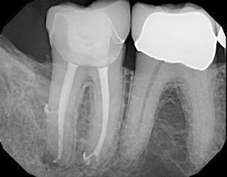 What's the Deal With GentleWave?