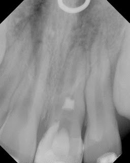 Apexification using Pulpal Regeneration