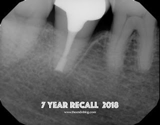 7 Yr Recall on Intentional Replantation