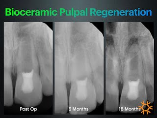 Bioceram pulp regen