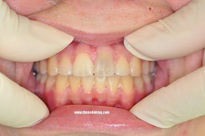 Calcific Metamorphosis