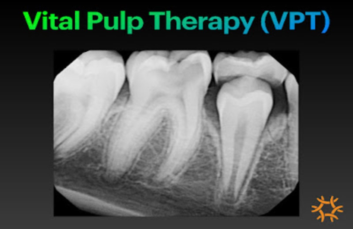 Clinical Steps for Vital Pulp Therapy
