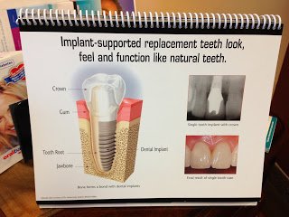 The Longevity of Teeth and Oral Implants