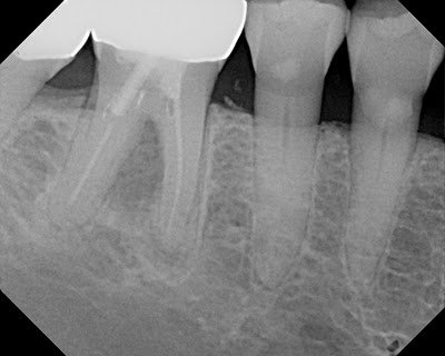 Successful Perforation Repair using MTA