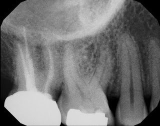 Periapical film