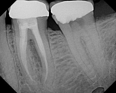 Clinical Clues for Identifying Cracked/Fracture Roots