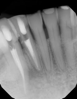 Don't Just Assume A Root Is Fractured When You See Lateral Bone Loss