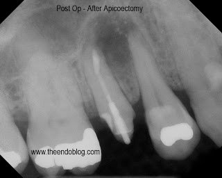 Apicoectomies Save Teeth