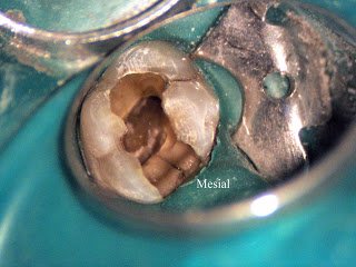 5 Year Recall on a Cracked Tooth
