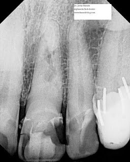 Avoiding Root Canal Therapy with MTA