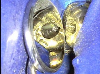 Value and Limitations of CBCT in Endodontics-Case Report