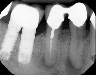 Lateral Portals of Exit