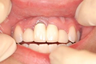 Why Is It Better to Save a Natural Tooth?