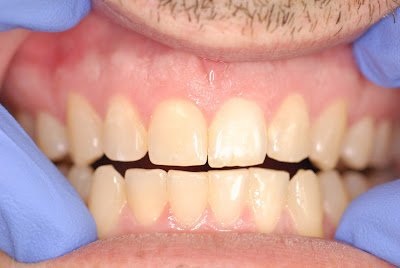 Pulpal Regeneration - More Evidence