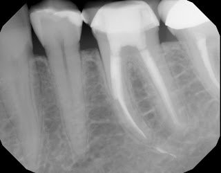 CBCT as Aid In Removal of Separated File