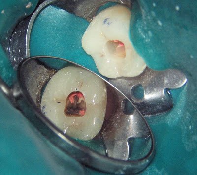 Missed Canals Cause Root Canal Failure