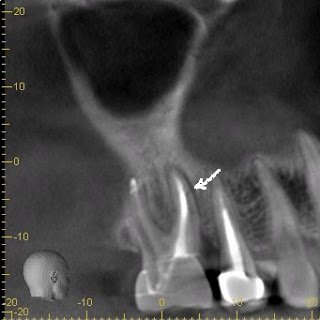 Using CBCT to Identify Vertical Root Fractures