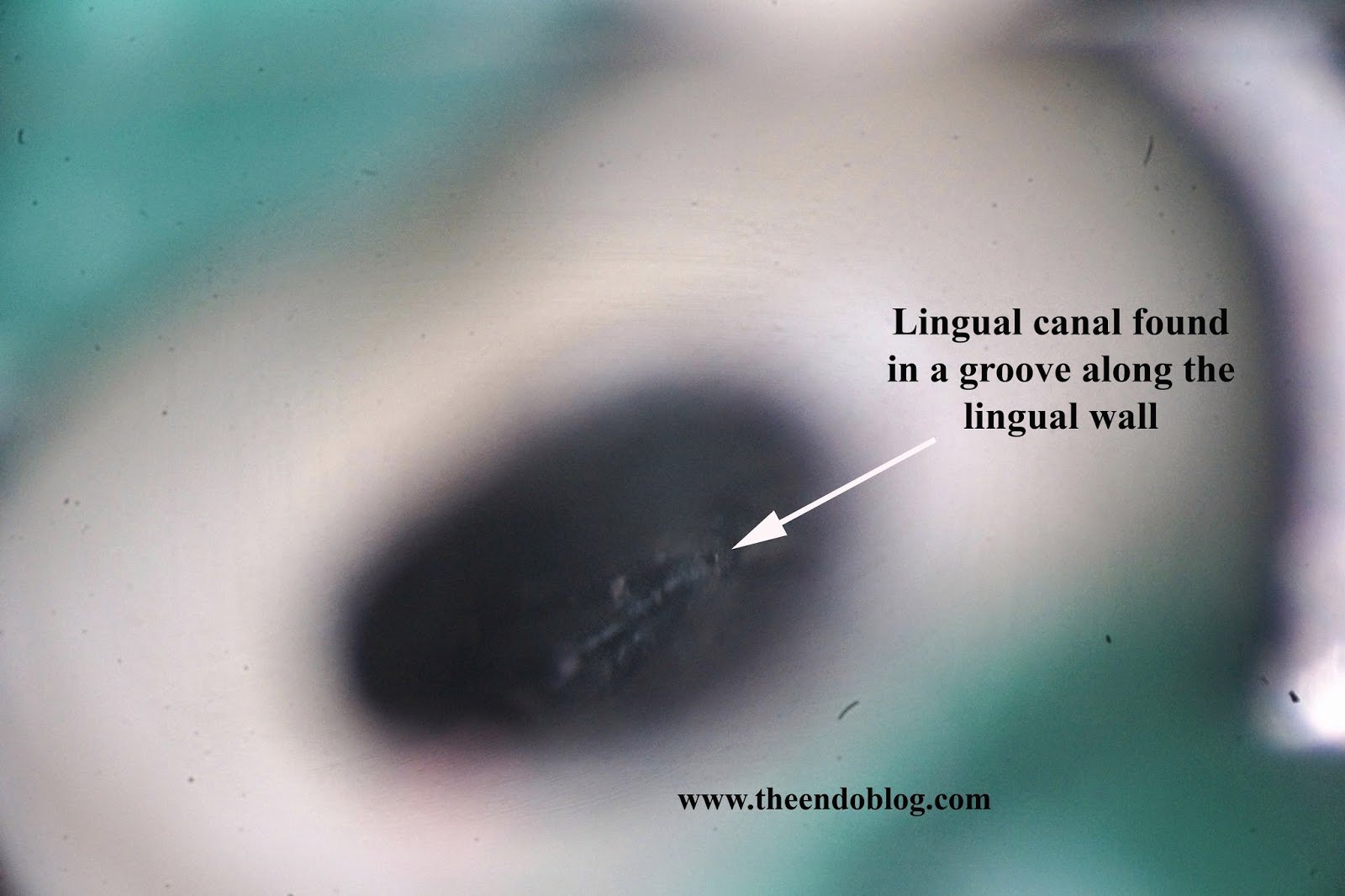 CBCT in Endodontics to Treat Difficult Anatomy & Preserve Teeth