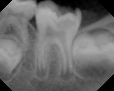 Success with Vital Pulp Therapy