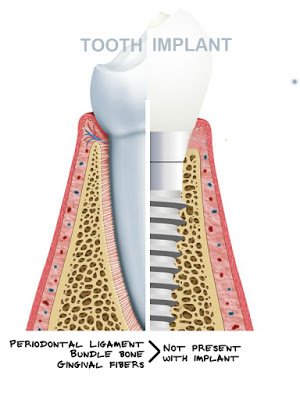 Are Dental Implants Forever?
