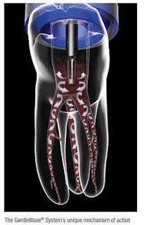 GentleWave by Sonendo